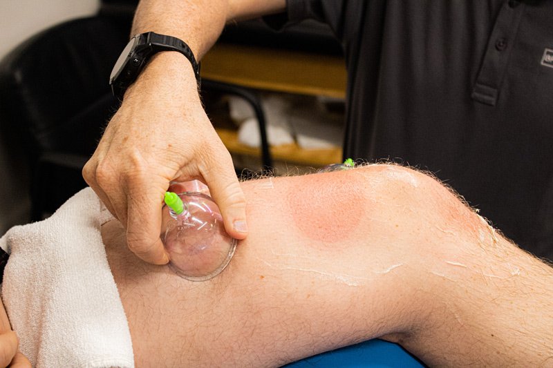 Close-up-of-therapist-performing-cupping-therapy-on-a-patient’s-knee-with-visible-red-circular-marks