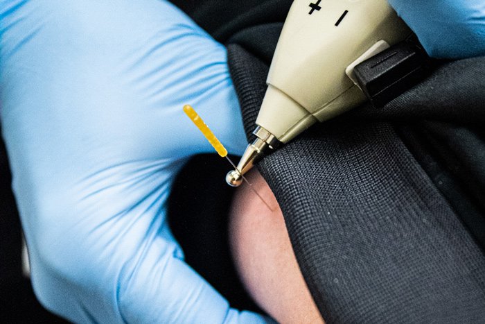 Close-up-of-a-therapist-inserting-a-dry-needle-into-a-patient’s-skin-with-an-electrical-stimulation-device-for-therapy