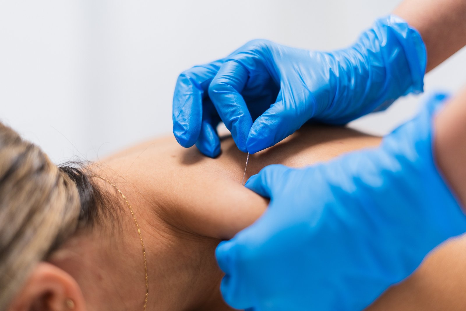 women receiving trigger point dry needling therapy in her back
